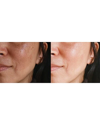 Skin Rejuvenation Device Women 4 Skin Rejuvenation Device Women - Image 2